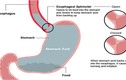 Cách giảm tức thời chứng trào ngược thực quản