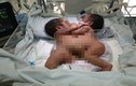 Bộ trưởng Y tế: "Tìm mọi cách để cứu sống hai bé dính liền"