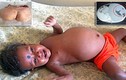 Hy hữu bé 15 tháng “mang nặng” bào thai song sinh 3kg
