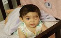 Em bé bẩm sinh một mắt không có nhãn cầu