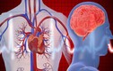 Cách phân biệt đau tim với đột quỵ để tránh mất mạng