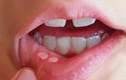 Video: Cách phân biệt nhiệt miệng và ung thư khoang miệng