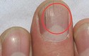 Video: Nhận biết gan nhiễm độc qua 3 dấu hiệu bất thường của móng tay