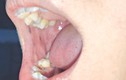 Phát hiện sớm bệnh hiểm từ các nốt sắc tố sậm màu trong miệng