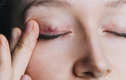 5 nguyên nhân gây ra tình trạng nổi u trên mí mắt