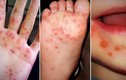 Hà Nội: Ca mắc tay chân miệng tăng nhanh