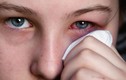 Hiểu bệnh đau mắt đỏ để dập dịch
