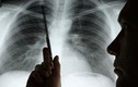 Kéo dài thời gian sống cho bệnh nhân ung thư phổi