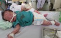 Cứu sống bé sơ sinh bị thủy đậu chứng xuất huyết phổi