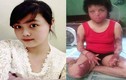 Hành trình tìm lại cuộc sống của cô gái bị chồng tẩm xăng thiêu sống