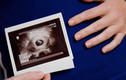 Hà Nội: Người phụ nữ bất ngờ khi bác sĩ thông báo có thai ở lách