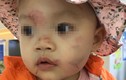 Nghi vấn bé gái 14 tháng bị “đánh” bầm dập ở lớp mầm non Hoa Sen