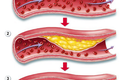 Học cách chung sống với bệnh mỡ máu, mỡ gan, tim mạch