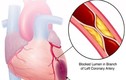 Mối liên hệ giữa bệnh mỡ máu cao và bệnh tim mạch 