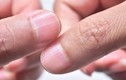 Bàn tay xuất hiện 5 dấu hiệu này chứng tỏ mắc bệnh gan
