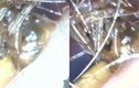 Video: Rùng mình xem cảnh lấy con nhện đã chết mắc kẹt trong tai bé trai