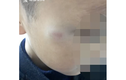 Vô tình chạm vào ngực cô giáo, bé trai 7 tuổi bị đánh tím mặt