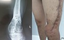 Bác sĩ kể lại hành trình 5 năm cứu chân chàng trai thối mủn lủng lẳng