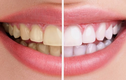 3 công thức tẩy trắng răng tại nhà vô cùng đơn giản 
