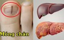 4 dấu hiệu ở bàn chân cảnh báo chức năng gan suy giảm