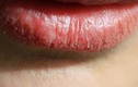 Người có gan xấu thường có 4 biểu hiện trên môi
