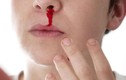 Chảy máu mũi do thói quen nhiều người hay làm, dấu hiệu bệnh hiểm