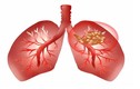 Làm thế nào để xua tan các nốt phổi được phát hiện? 