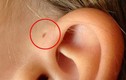 Mối nguy từ lỗ nhỏ hay bị bỏ qua ở vành tai