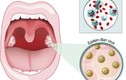 Một số bệnh do virus lây truyền qua nụ hôn