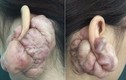 Kinh hãi những vành tai biến dạng vì thú chơi nong tai