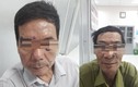 Hà Nội: Đi đốt nốt ruồi, 2 người đàn ông bất ngờ phát hiện ung thư