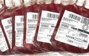 Tại sao AB là nhóm máu hiếm nhất thế giới?