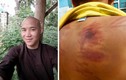 Thân thể bé trai 11 tuổi rướm máu, lở loét vì bị thầy chùa đánh đập dã man