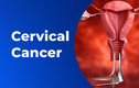 Ung thư cổ tử cung gây tử vong: Ai dễ mắc bệnh hơn?