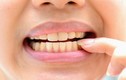 7 sự thật về tẩy trắng răng