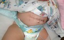 Hy hữu bé 10 ngày tuổi bị ung thư buồng trứng