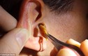 Hãi hùng khối ráy tai khổng lồ trong tai bệnh nhân