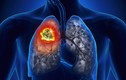 Những con số giật mình về ung thư phổi tại Việt Nam