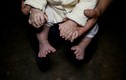 Căn bệnh kỳ lạ khiến cậu bé có 31 ngón tay chân