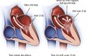 Bệnh hở van tim của Tuấn Hưng nguy hiểm ra sao?