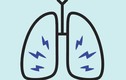 9 dấu hiệu của bệnh ung thư phổi bạn cần lưu ý