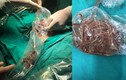 Phú Thọ: Mổ cấp cứu lấy búi giun khoảng 100 con cho bệnh nhi 11 tuổi