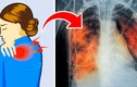 5 dấu hiệu báo động phổi bạn đang có vấn đề