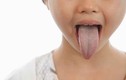 Nhận biết tình trạng sức khỏe qua các dấu hiệu của miệng