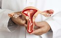 3 dấu hiệu trong kỳ kinh nguyệt cảnh báo ung thư cổ tử cung