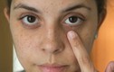 6 bước giúp bạn loại bỏ quầng thâm mắt hiệu quả cấp tốc