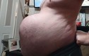 Hoãn phẫu thuật vì dịch, người đàn ông phải mang “bụng bầu 9 tháng”