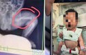 Xót xa bé trai 28 ngày tuổi bị bảo mẫu đánh gãy xương đùi