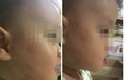 Hà Nội: Làm rõ bé gần 2 tuổi bị đánh bầm tím ở trường