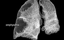 Cảnh báo bệnh tắc nghẽn phổi mãn tính ở người già